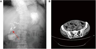 Platelet-rich plasma combined with lyophilizing thrombin powder for the treatment of complicated enterocutaneous fistula: a case report